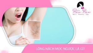 Long nách mọc ngược là gì?