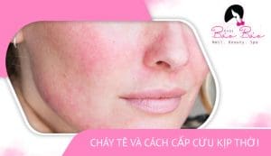 cháy ủ tê và cách cấp cứu kịp thời