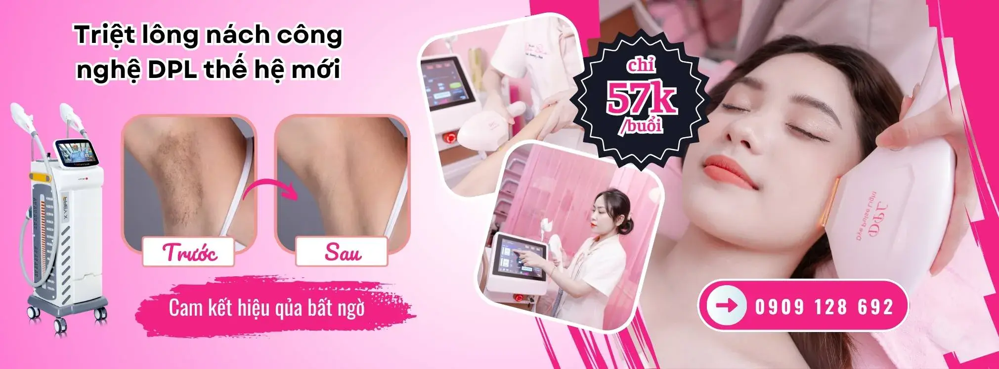 Khuyến mãi triệt lông tại Enbi Bảo Bảo