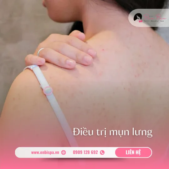 Điều trị mụn lưng