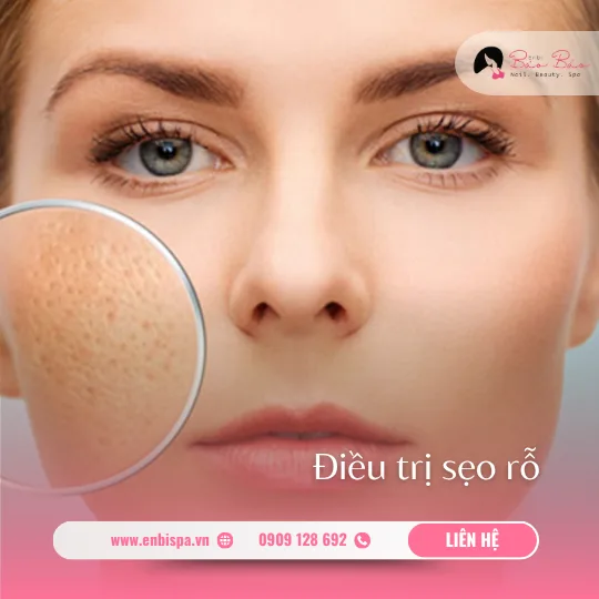 Điều trị sẹo rỗ